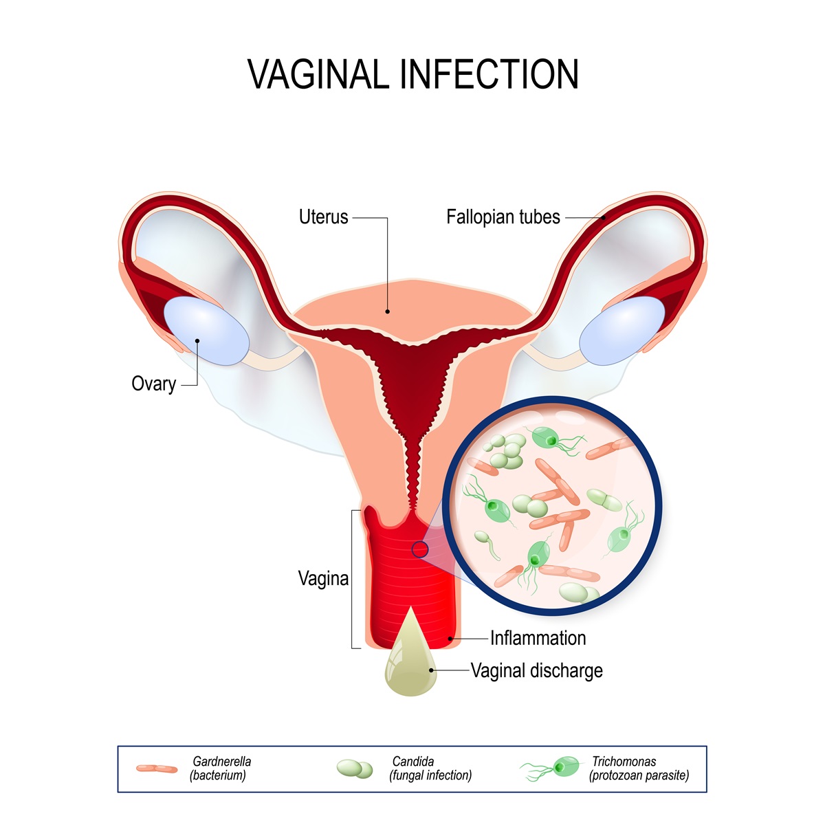 Vaginálny výtok v dôsledku infekcie a zápalu pohlavnej sústavy